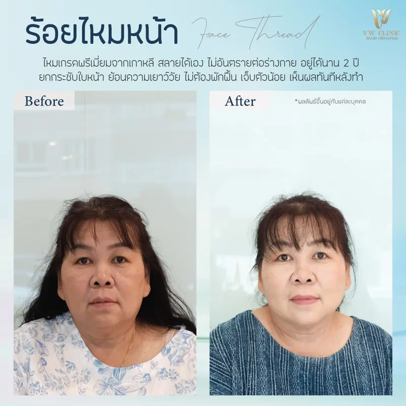 ร้อยไหมหน้า 10 เส้น