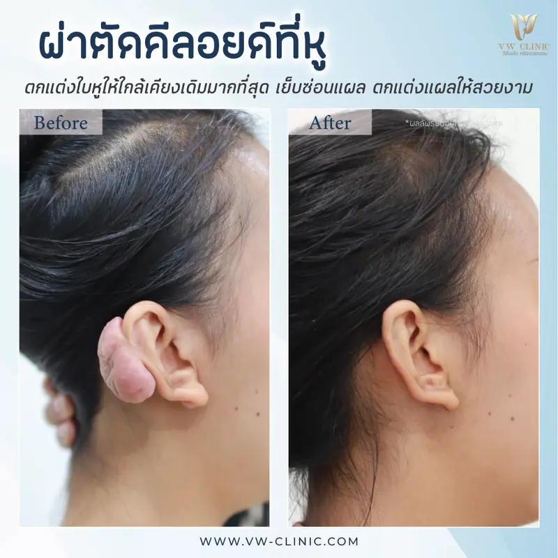 ผ่าตัดคีลอยด์หู