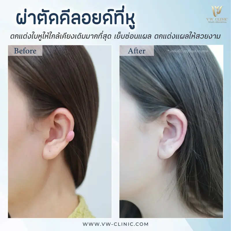ผ่าตัดคีลอยด์หู