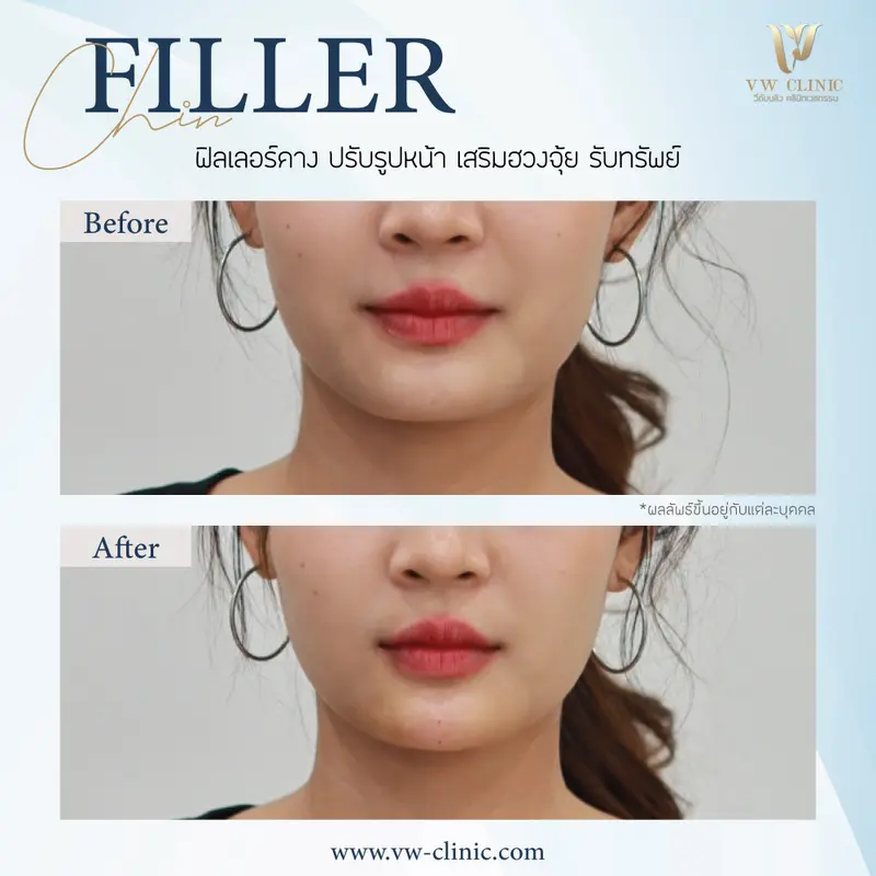Filler คาง