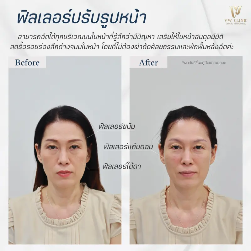 Filler ปรับรูปหน้า