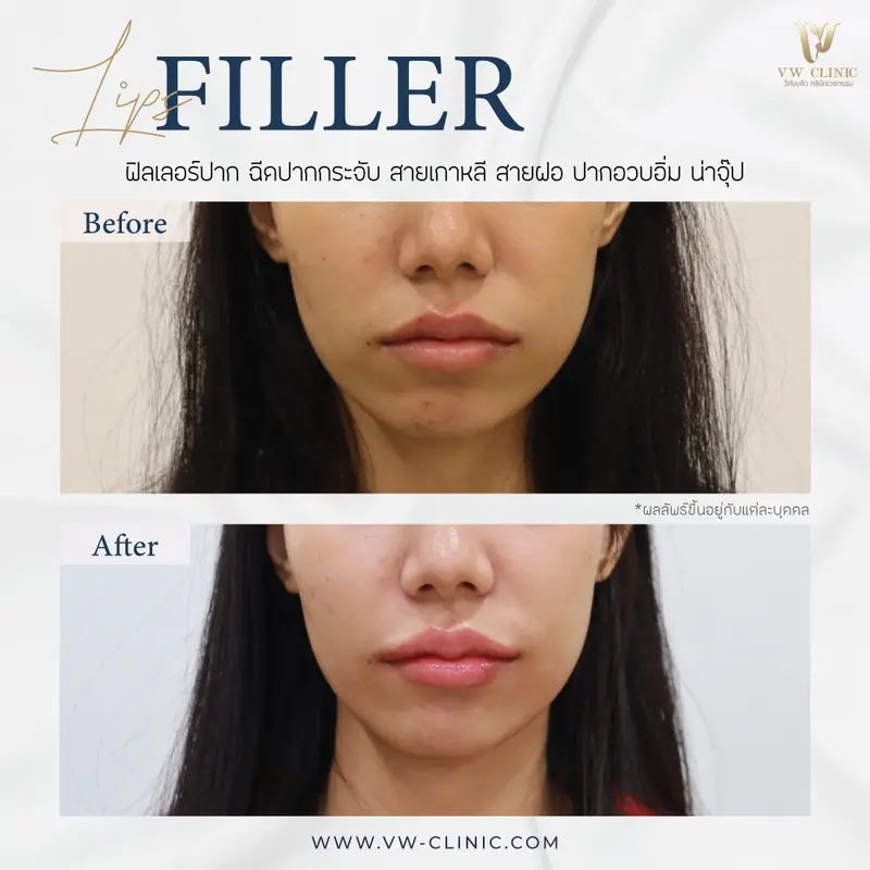 Filler ปาก
