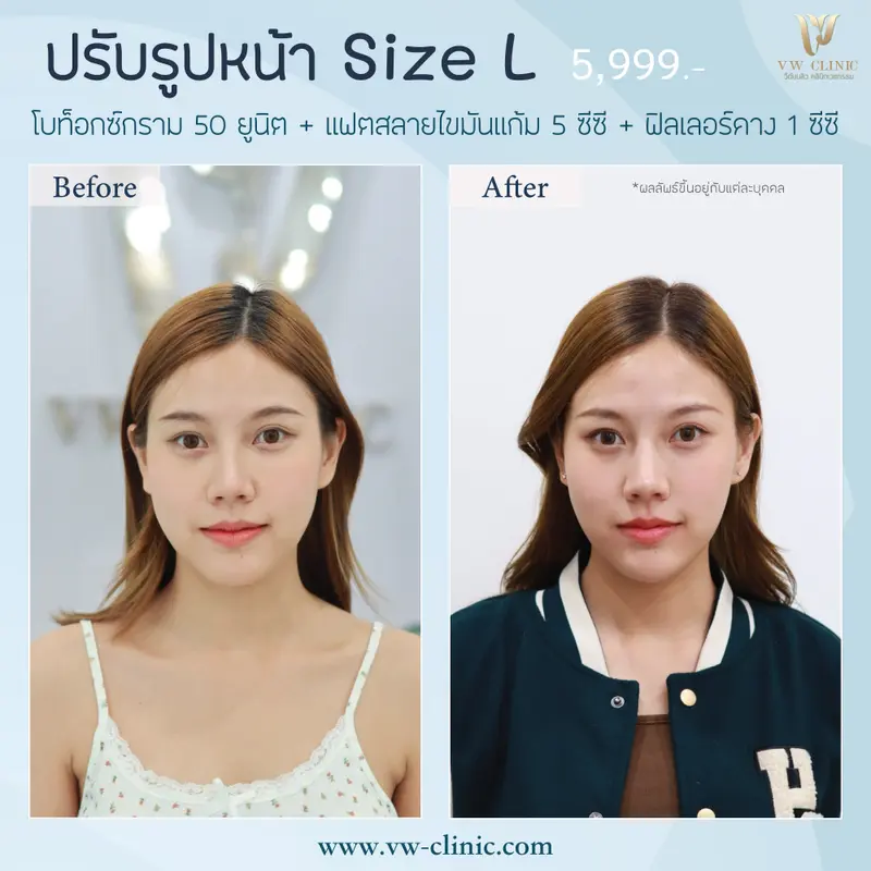 Botox กราม + Fat แก้ม + Filler คาง