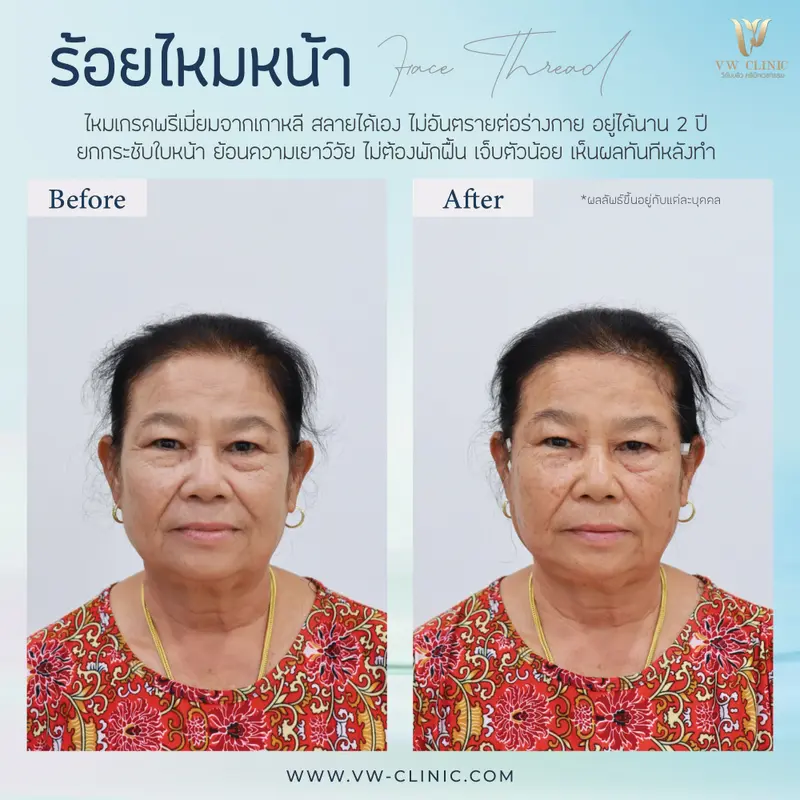 ร้อยไหมหน้า