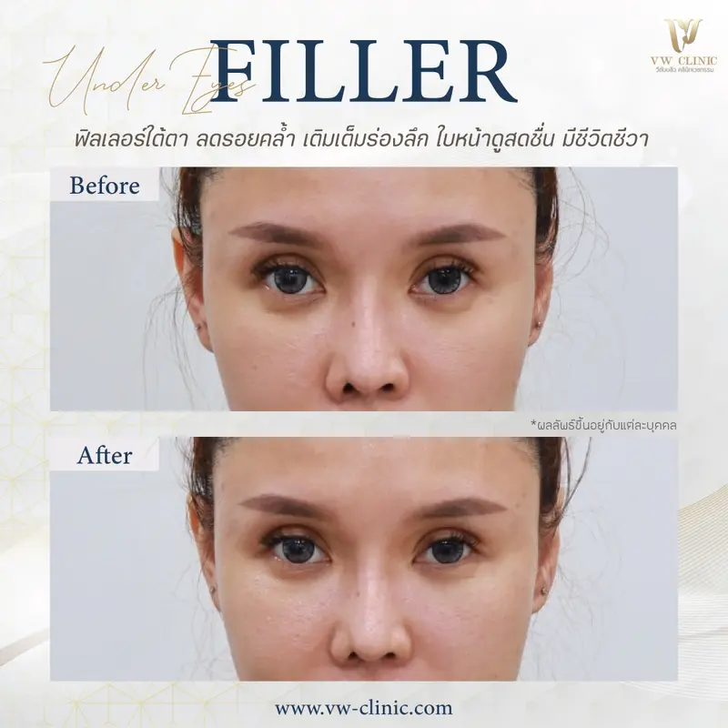 Filler ใต้ตา