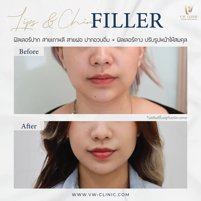 Filler ปาก + คาง