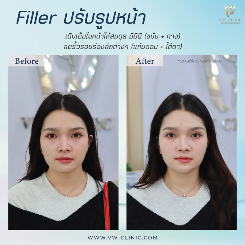 Filler ปรับรูปหน้า