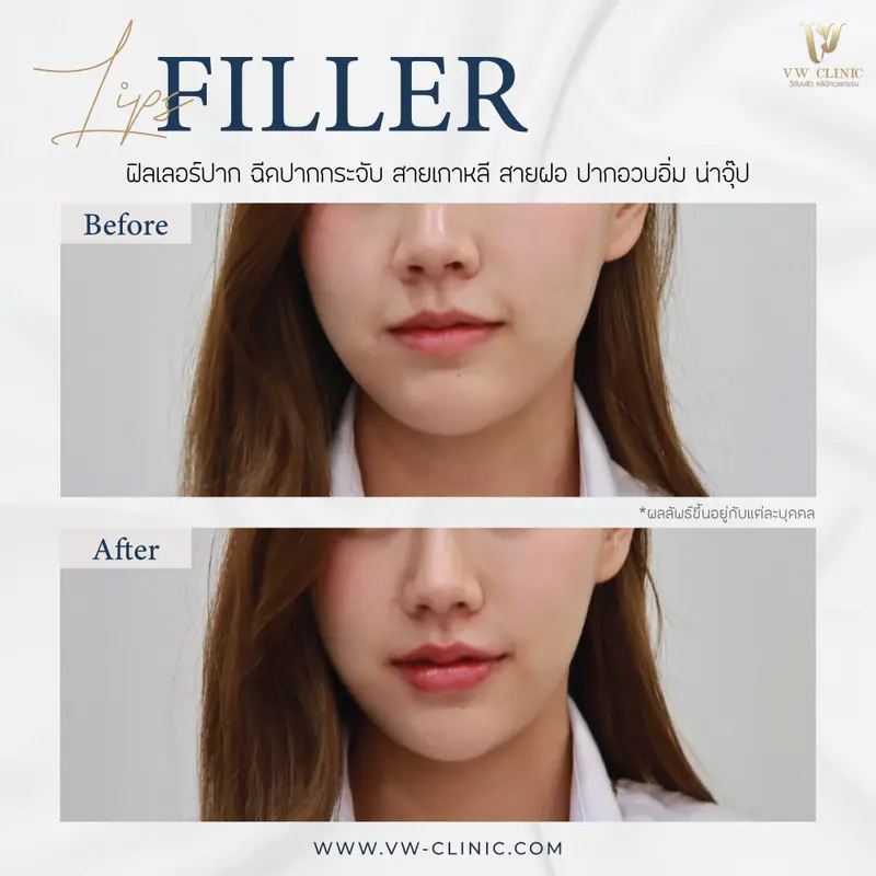 Filler ปาก