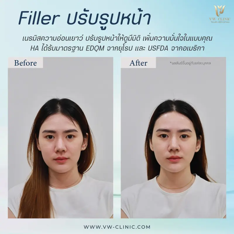 แก้มตอบ + คาง