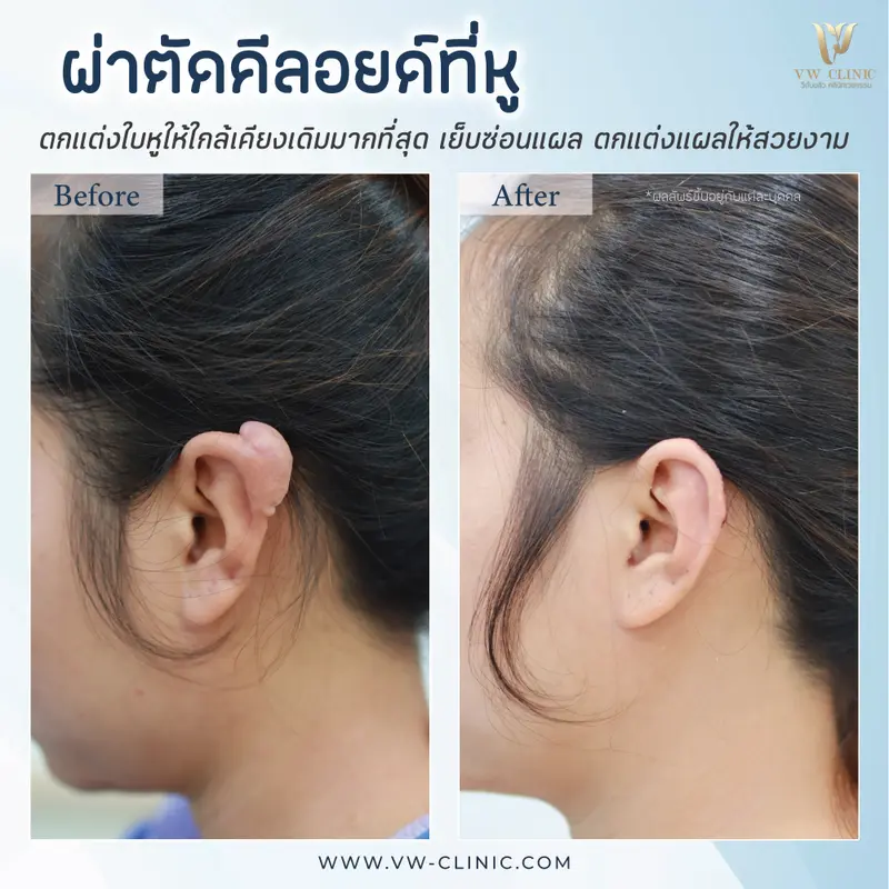 ผ่าตัดคีลอยด์หู