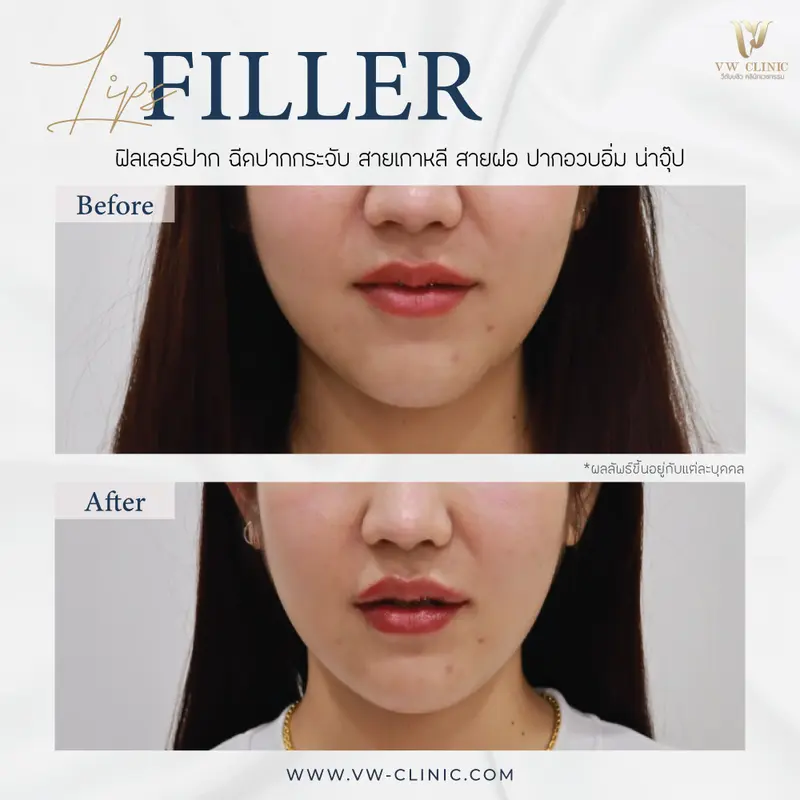 Filler ปาก