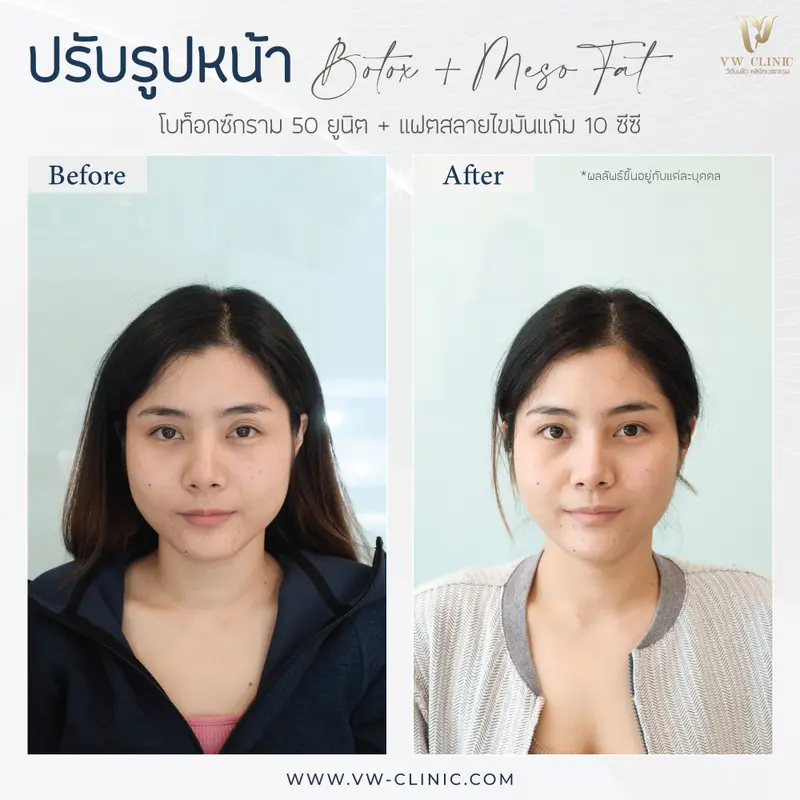 Botox กราม + Fat 10 cc แก้ม