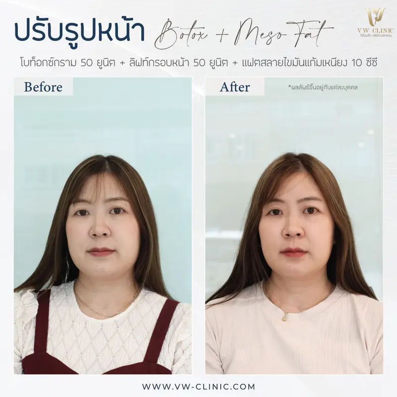 Botox กราม + lift กรอบหน้า + Fat 10 cc แก้มเหนียง