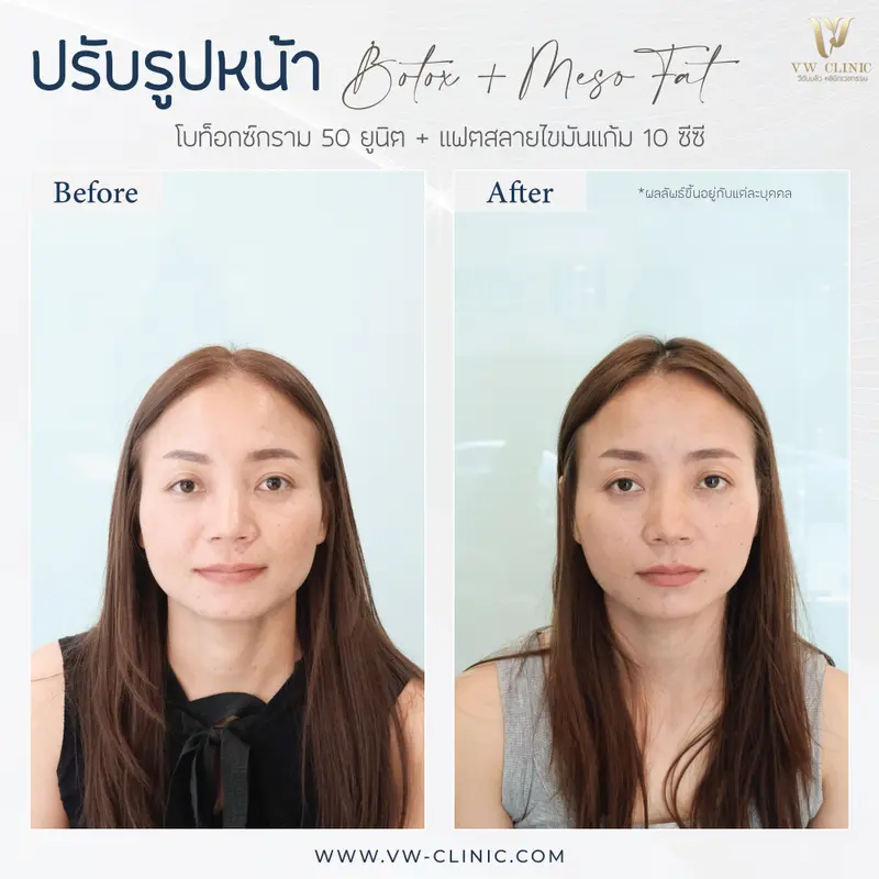 Botox กราม + Fat 10 cc แก้ม