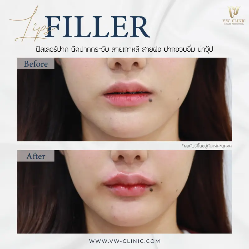 Filler ปาก