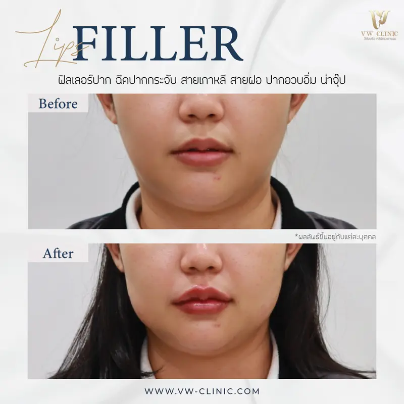 Filler ปาก