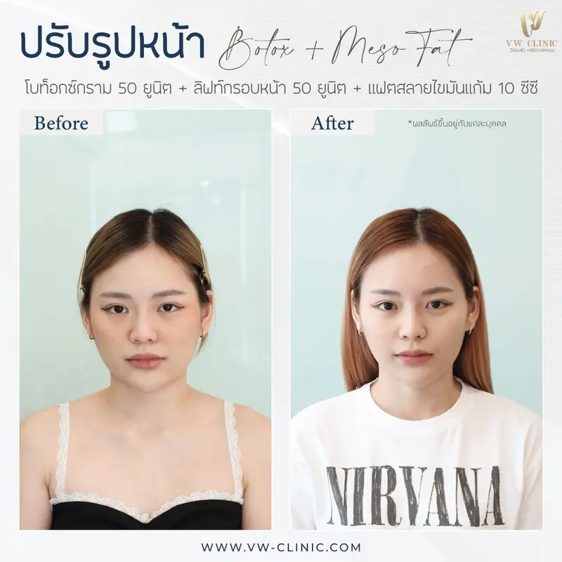 Botox กราม + ลิฟท์กรอบหน้า + Fat 10 cc แก้ม