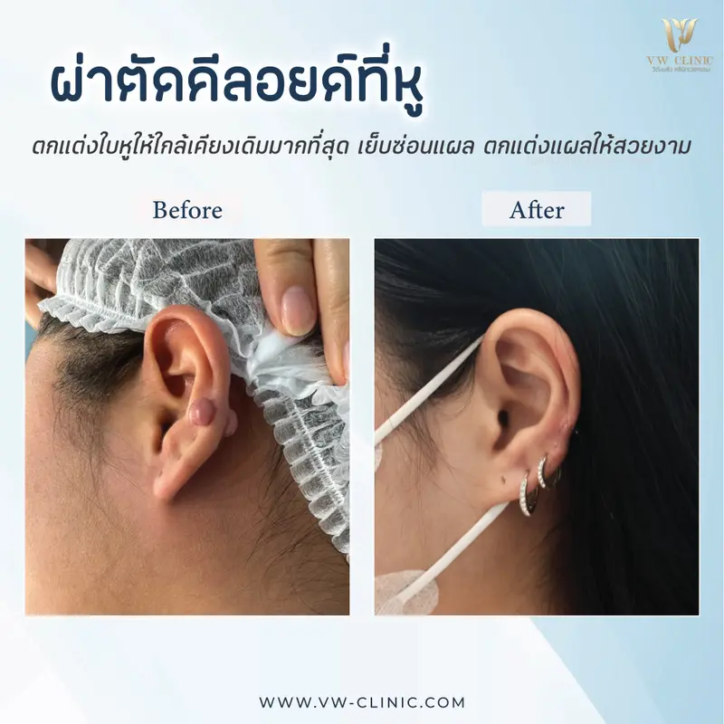 ผ่าตัดคีลอยด์หู