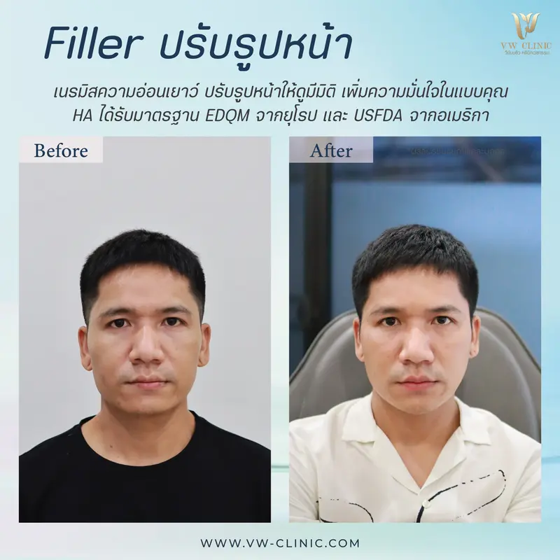 Filler ปรับรูปหน้า