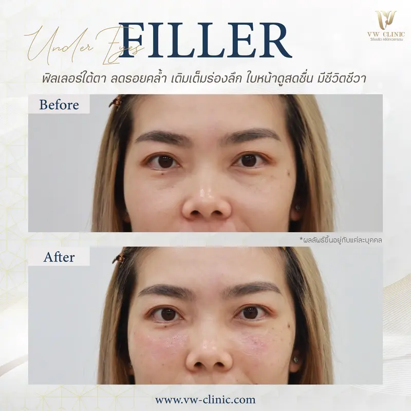 Filler ใต้ตา