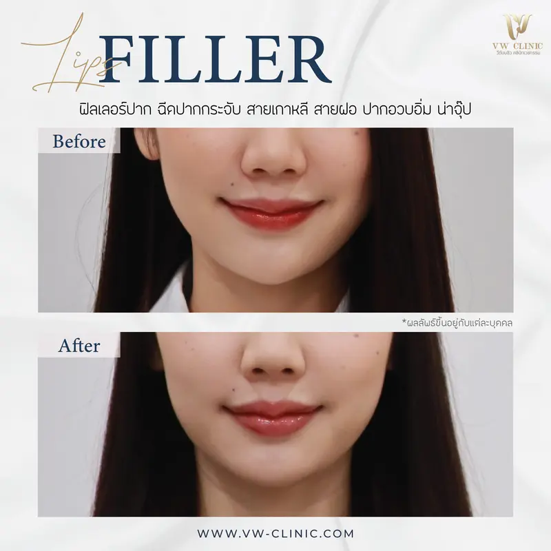 Filler ปาก