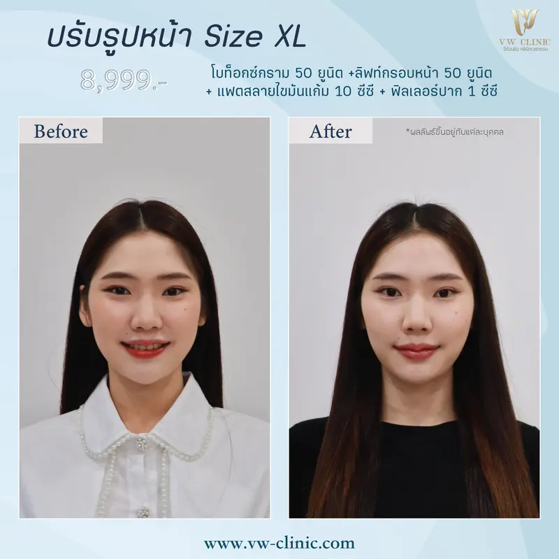Botox กราม + lift กรอบหน้า + Fat + Filler ปาก