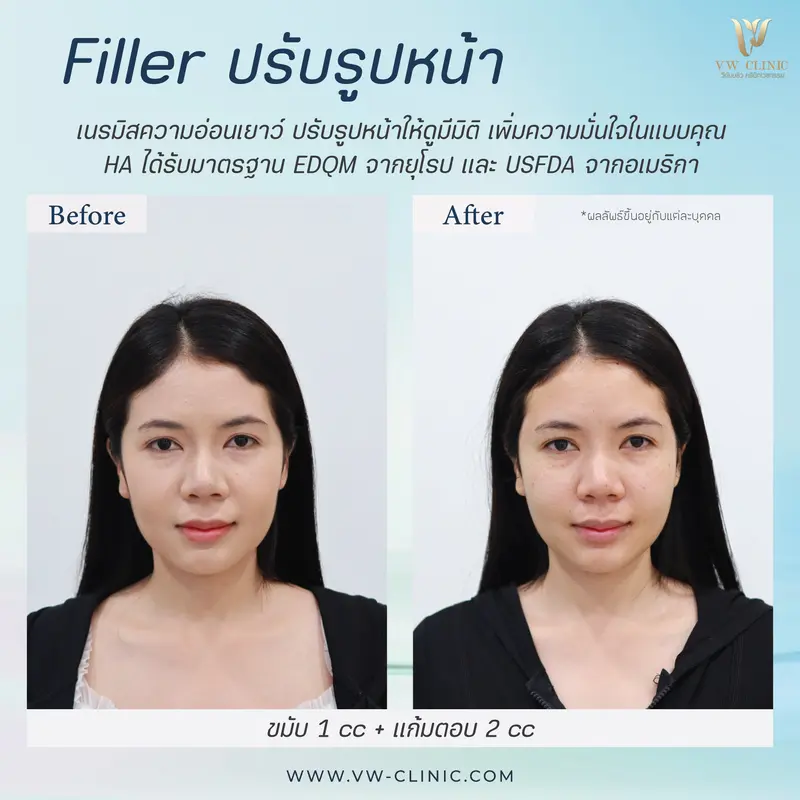 Filler ขมับ 1 cc + แก้มตอบ 2 cc