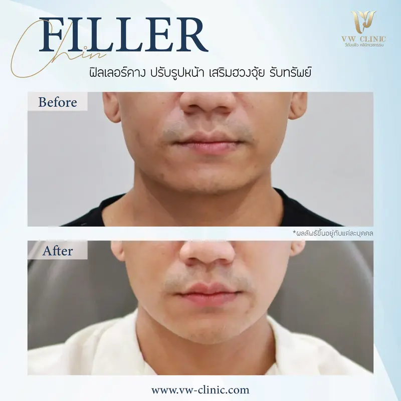 Filler คาง