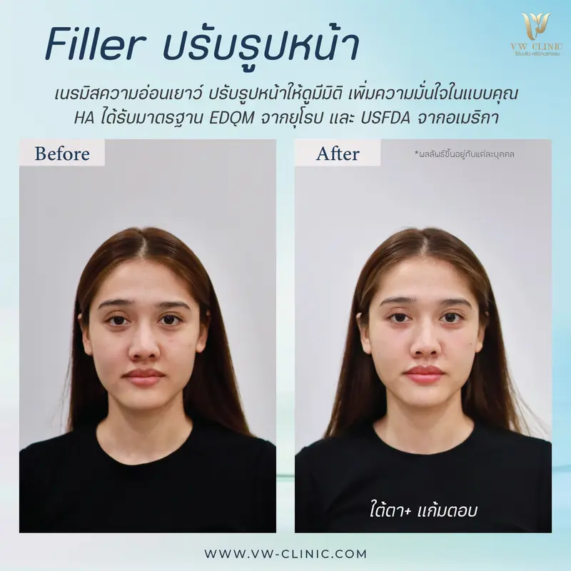 Filler ใต้ตา + แก้มตอบ