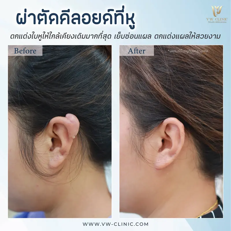 ผ่าตัดคีลอยด์หู