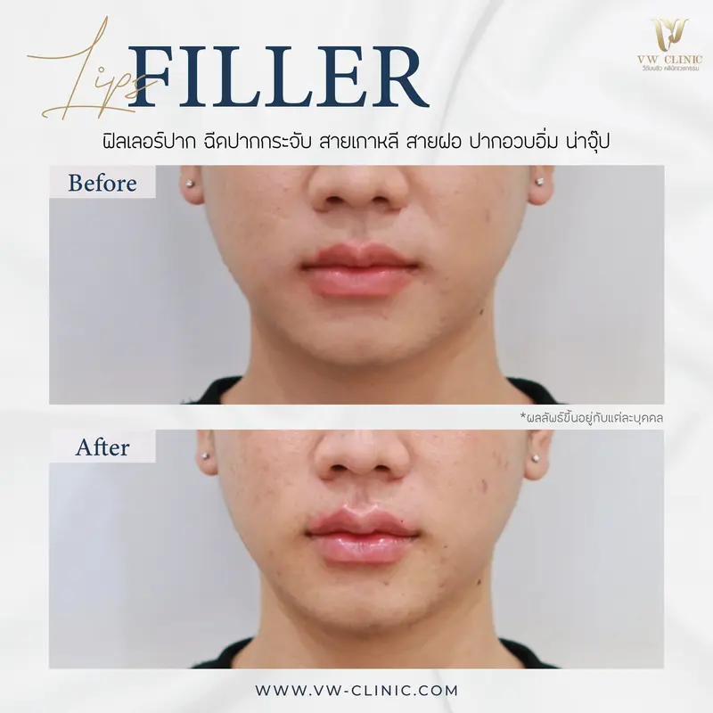 Filler ปาก