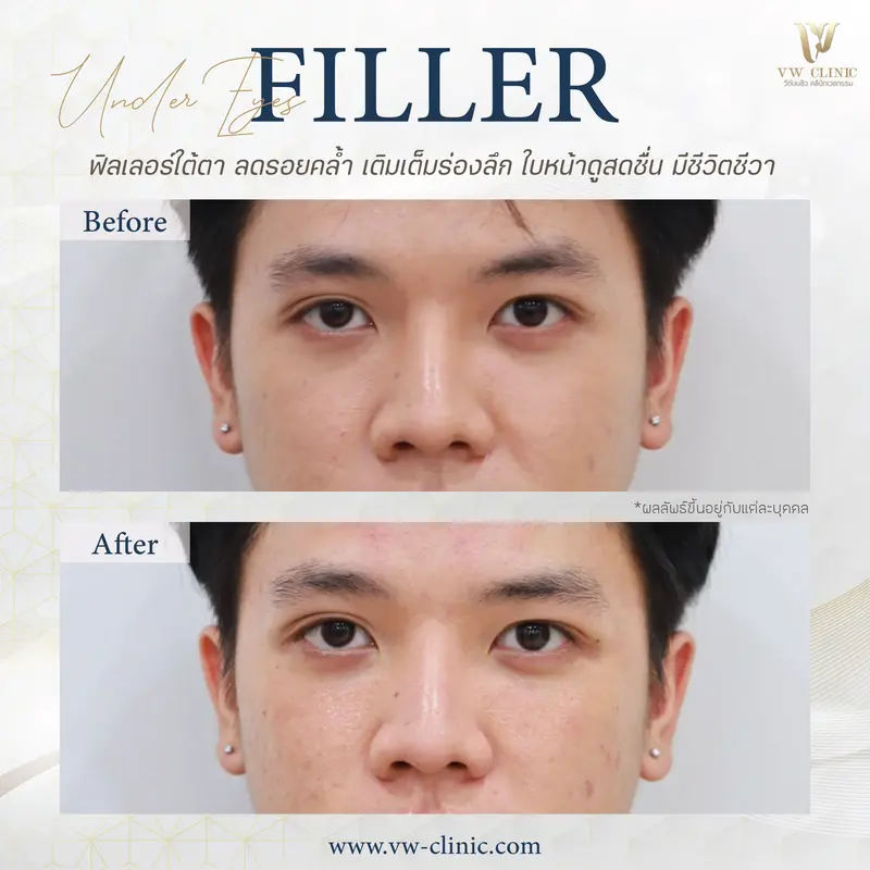 Filler ใต้ตา