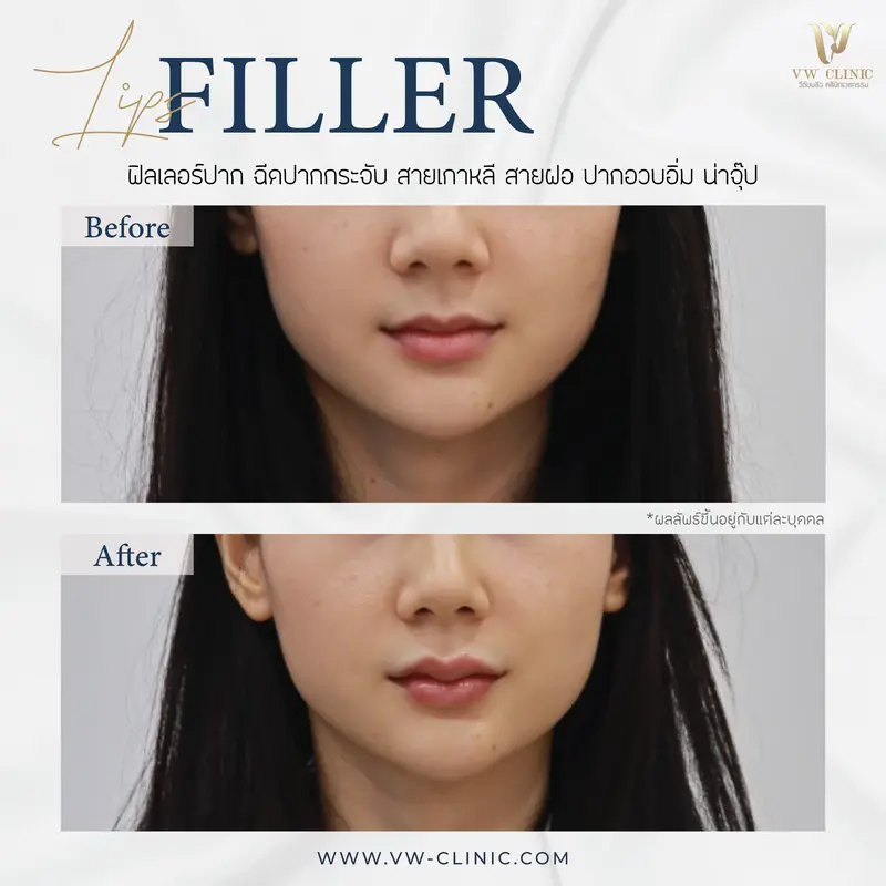 Filler ปาก