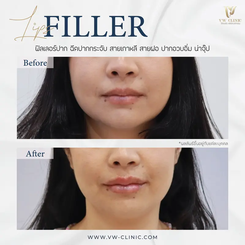 Filler ปาก