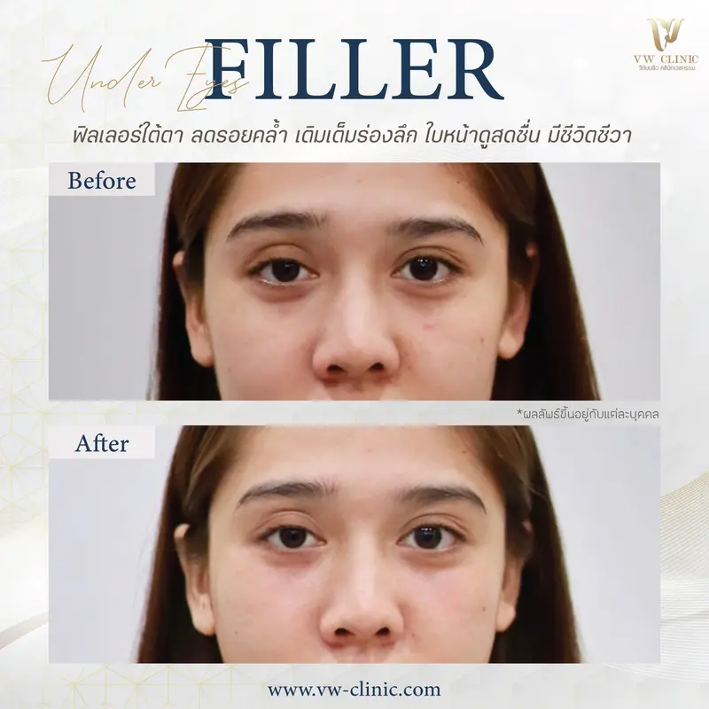 Filler ใต้ตา