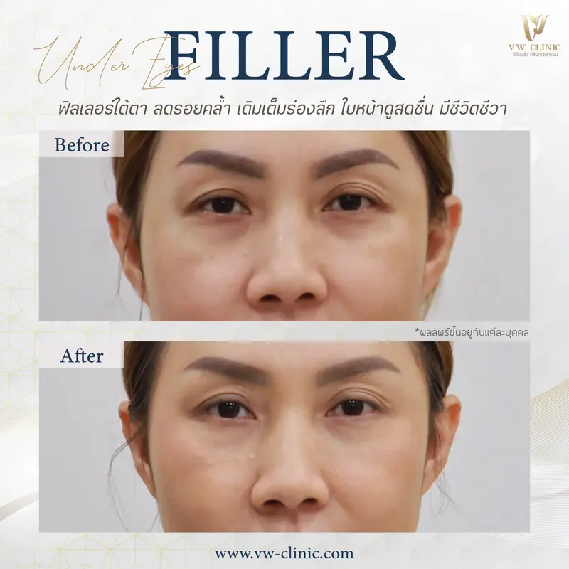 Filler ใต้ตา