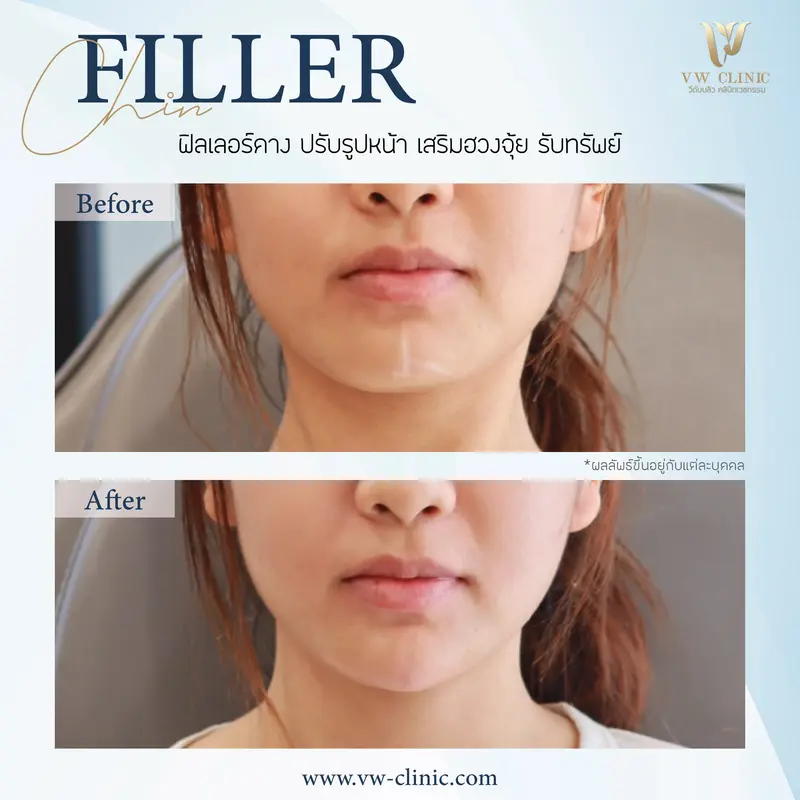 Filler คาง