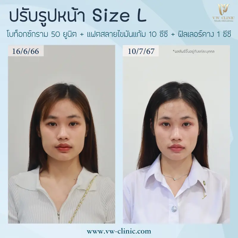 Botox + Fat + Filler