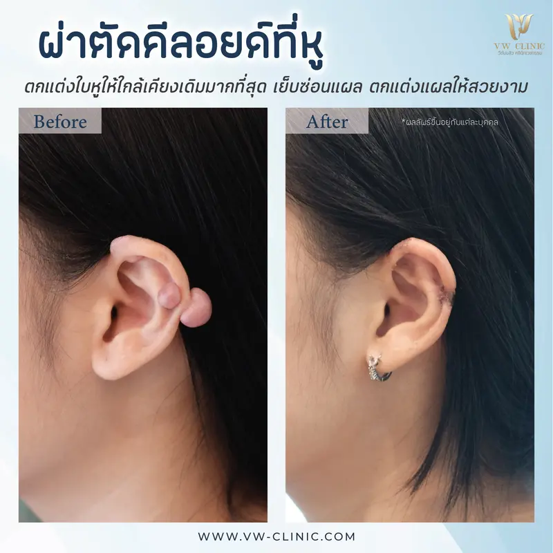 ผ่าตัดคีลอยด์หู