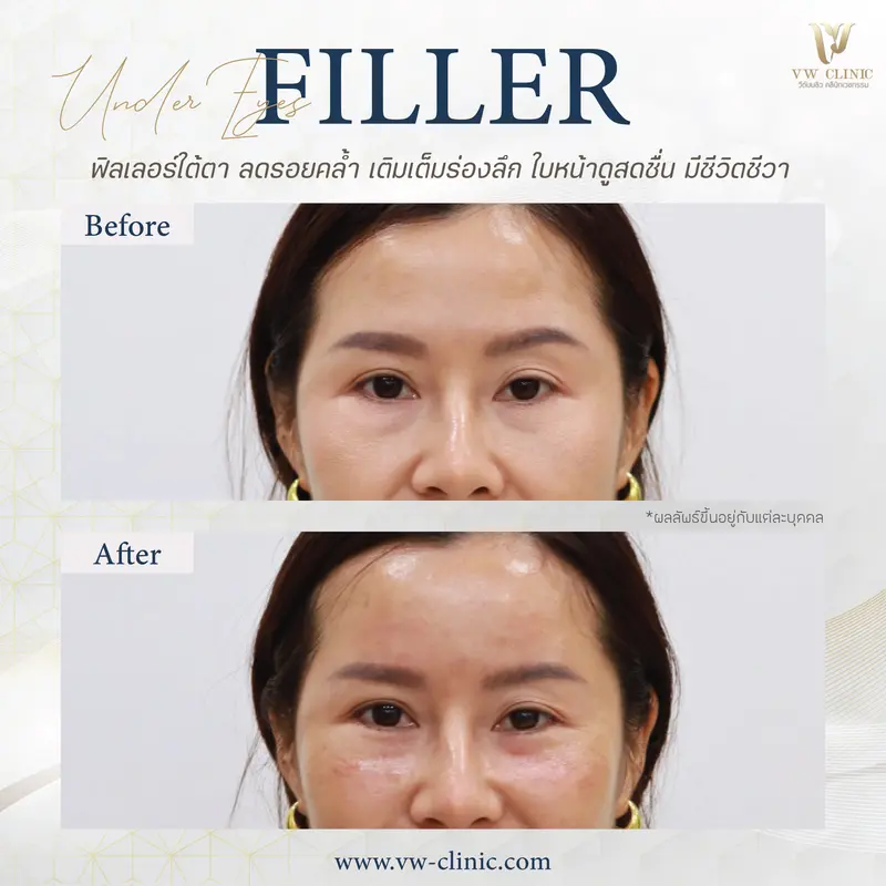 Filler ใต้ตา