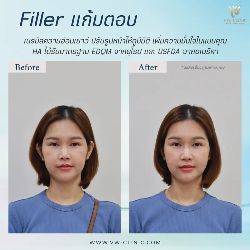 Filler แก้มตอบ