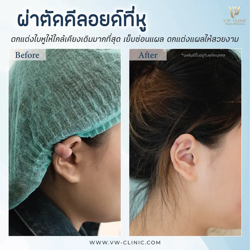 ผ่าตัดคีลอยด์หู