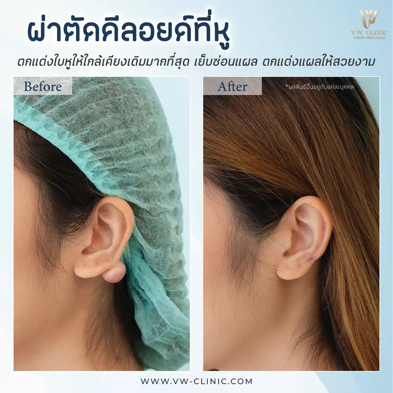 ผ่าตัดคีลอยด์หู