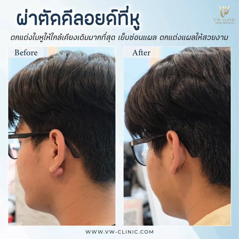 ผ่าตัดคีลอยด์หู