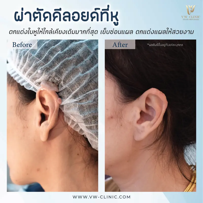 ผ่าตัดคีลอยด์หู