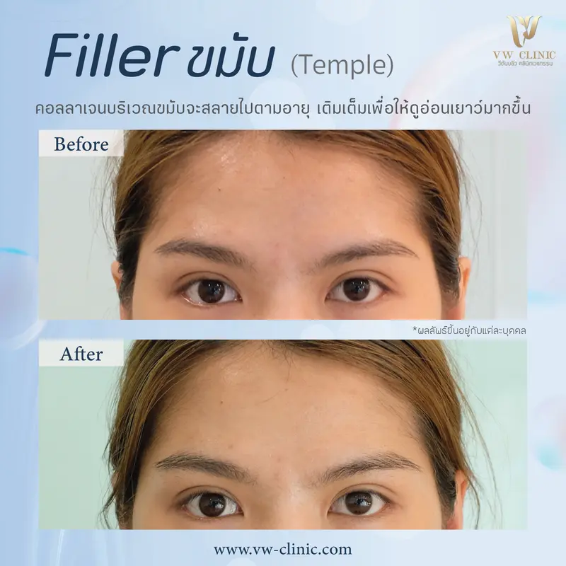 Filler ขม้บ