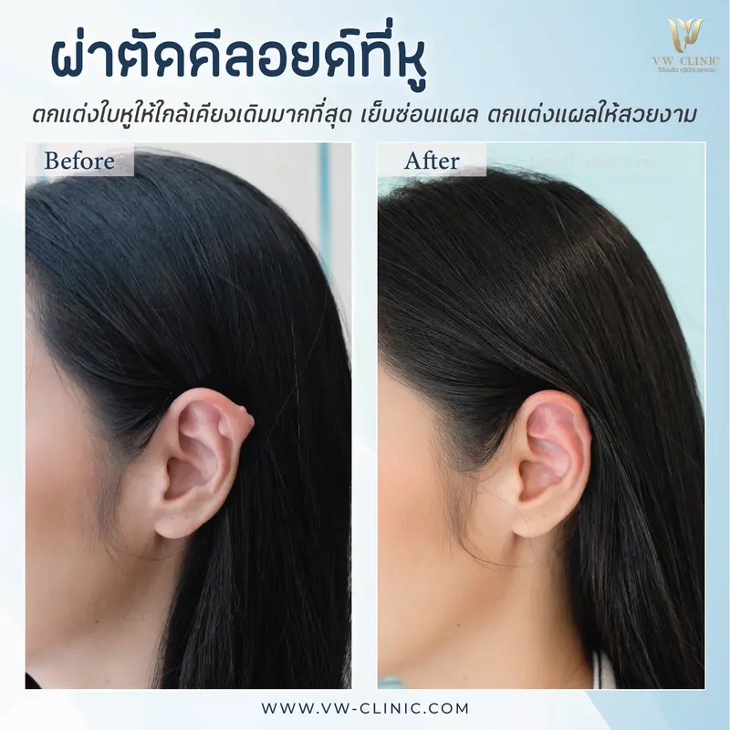 ผ่าตัดคีลอยด์หู