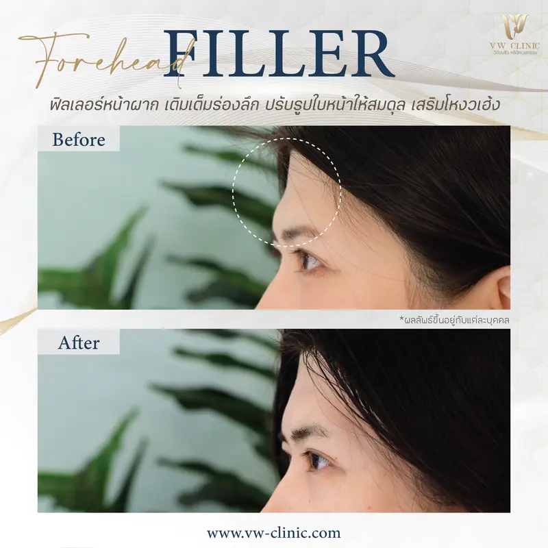 Filler หน้าผาก