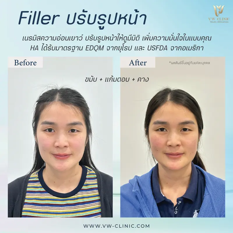 Filler ขมับ + แก้มตอบ + คาง