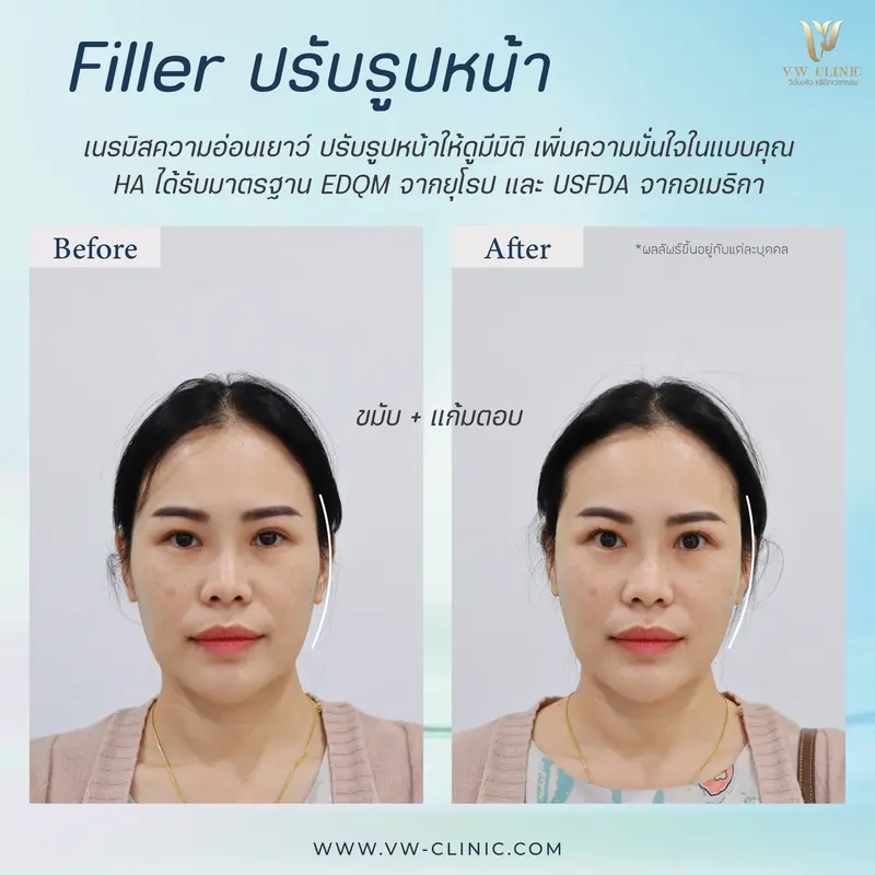 Filler ขมับ + แก้มตอบ